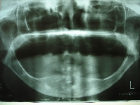 骨折はぴったりした入れ歯を使用することで、ある程度予防できます